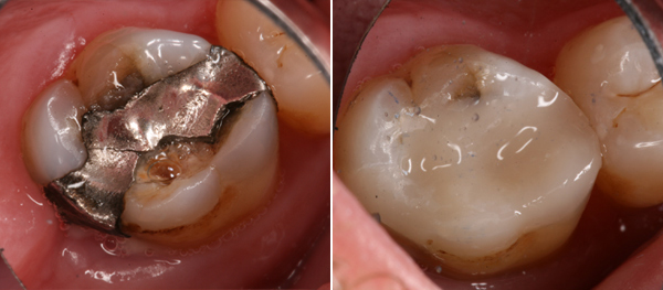 Replacing Silver Fillings