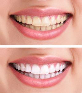 Dental Veneers