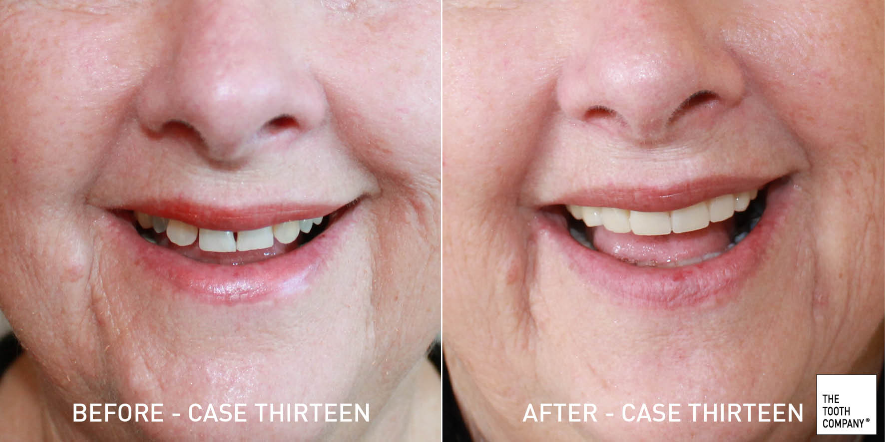 Full Mouth Reconstruction