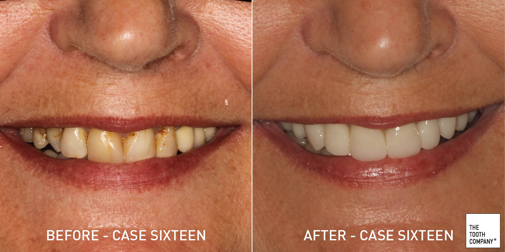 Full Mouth Reconstruction