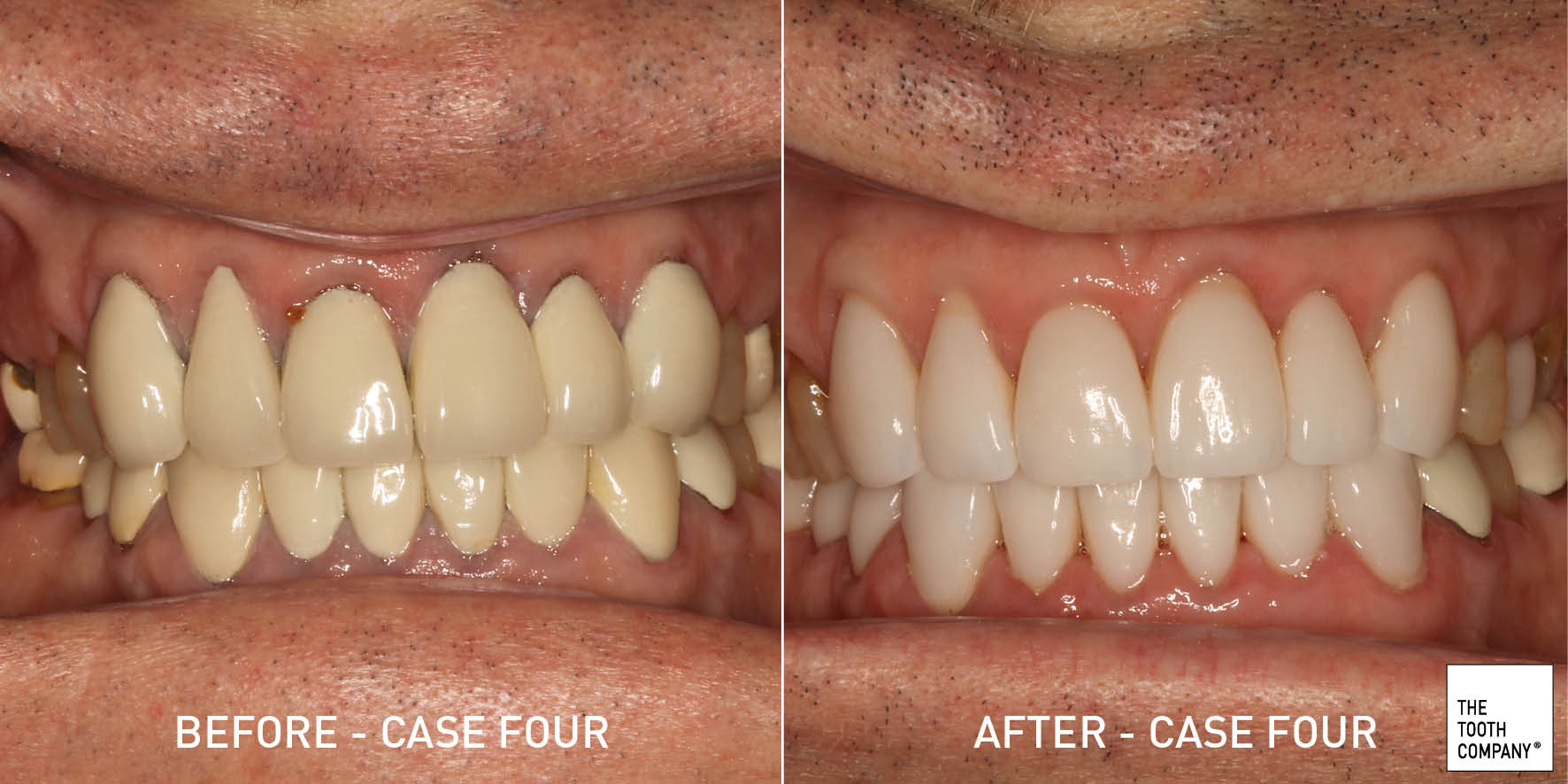 Full Mouth Reconstruction