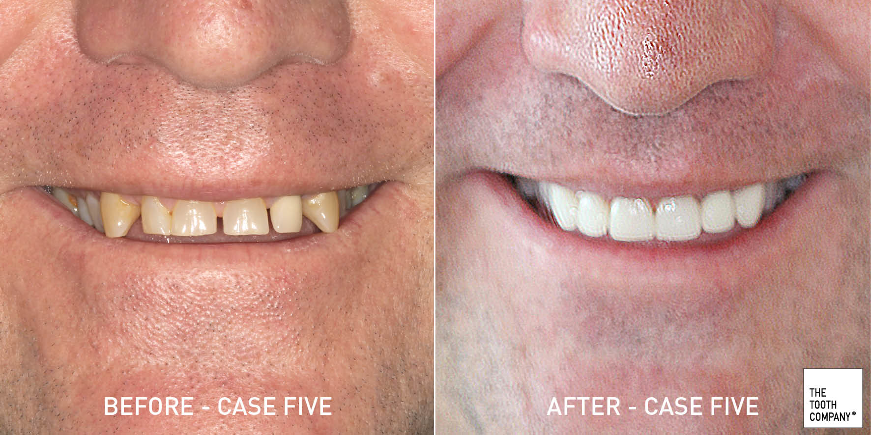 Full Mouth Reconstruction