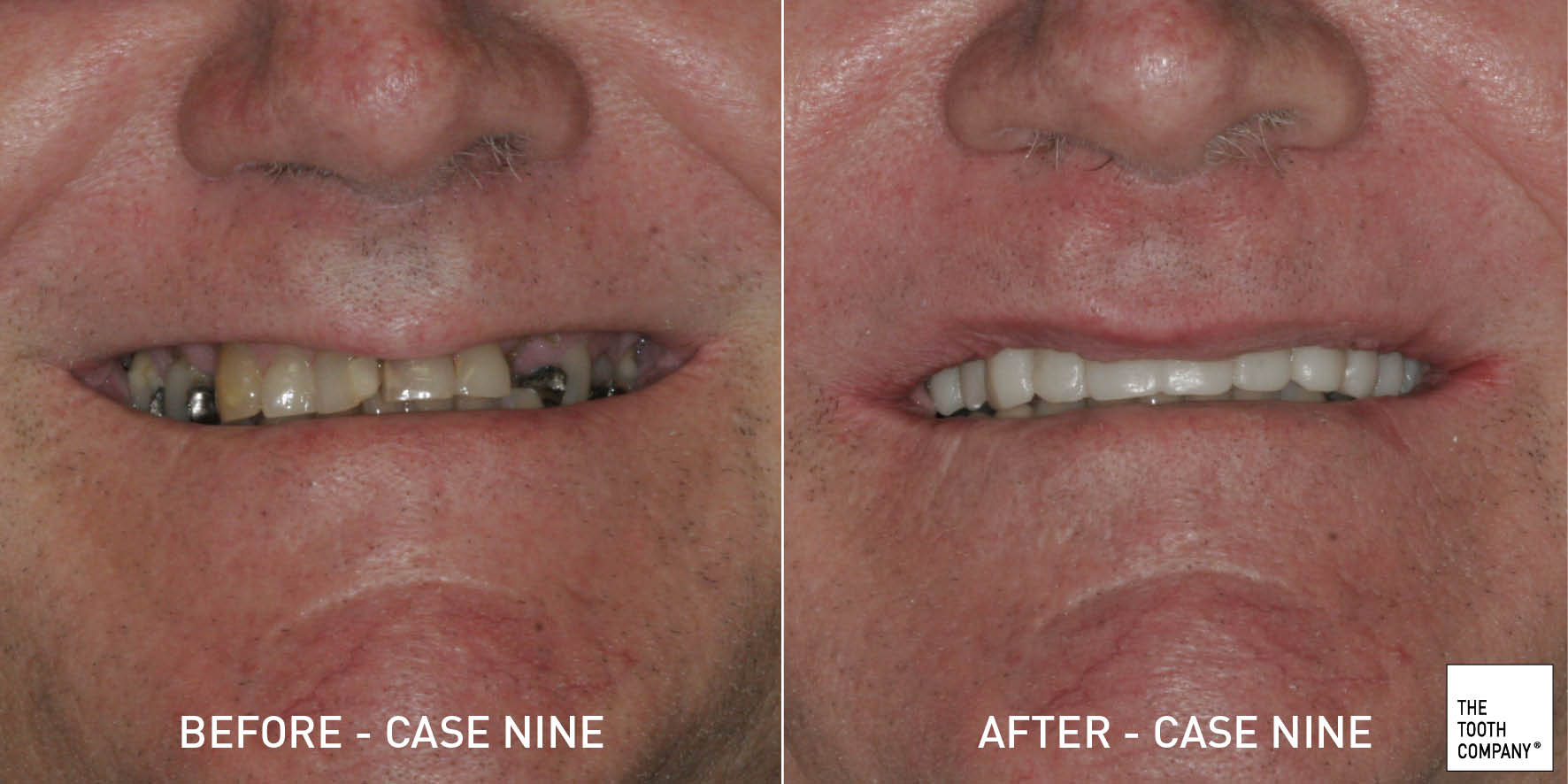 Full Mouth Reconstruction