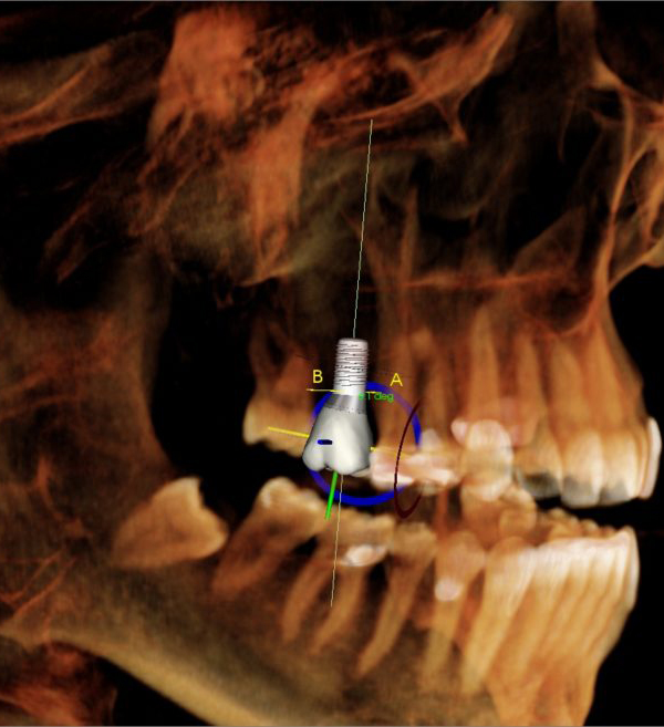 Dental Implants